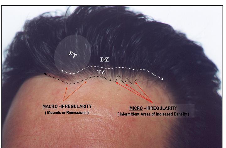 The area of this extended hairline is ~30cm 2 & requires 600-900 FU to create an initial density of 20-30 FU/cm 2 This extended hairline region can than be divided into three smaller zones: The