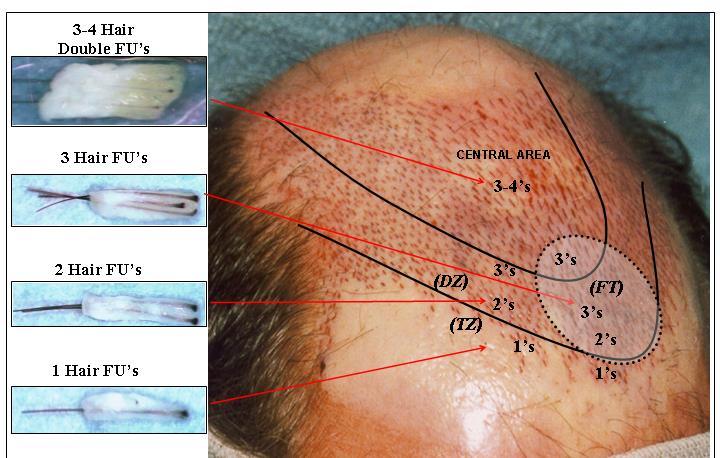 The Transition zone (TZ) should contain primarily one-hair FU s.
