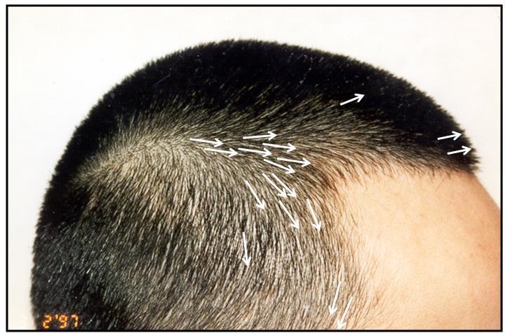 -9) The hair along the frontal hairline is usually directed anteriorly and leaves the scalp at approximately a 10-15 angle.