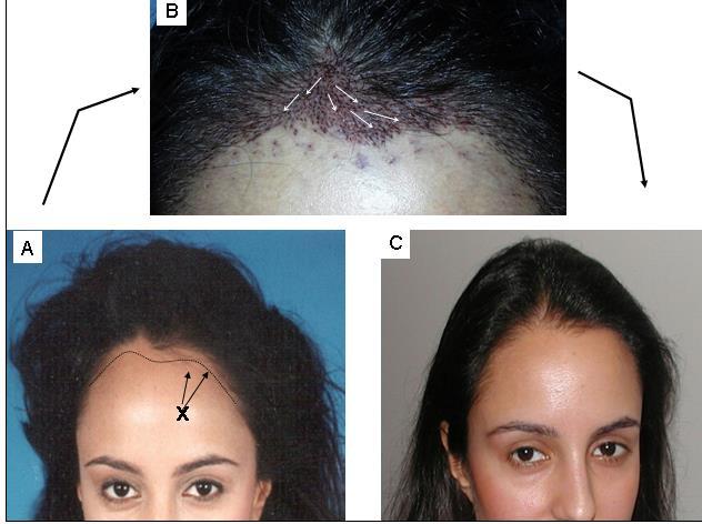 8 10 ;RECREATING A COWLICK: (A)This female patient who wanted her hairline ered, had a strong existing cowlick.