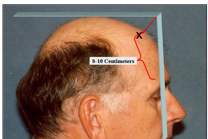 C) 1 year after tranplant PROPER PLACEMENT OF THE ANTERIOR BORDER OF THE HAIRLINE One of the most important principles of hairline placement is Don t place the hairline too low.