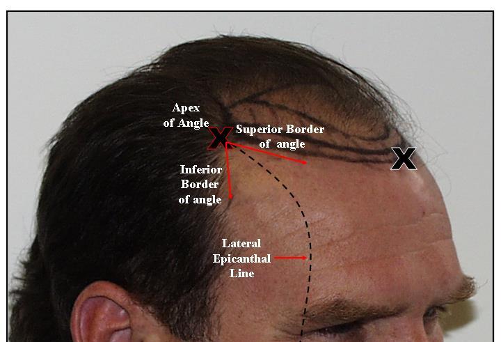 9 PROPER PLACEMENT OF LATERAL BORDER OF THE HAIRLINE AND THE FRONTO- TEMPORAL ANGLE All-mature male hairlines have a fronto-temporal angle, which is formed by the junction of the frontal and temporal