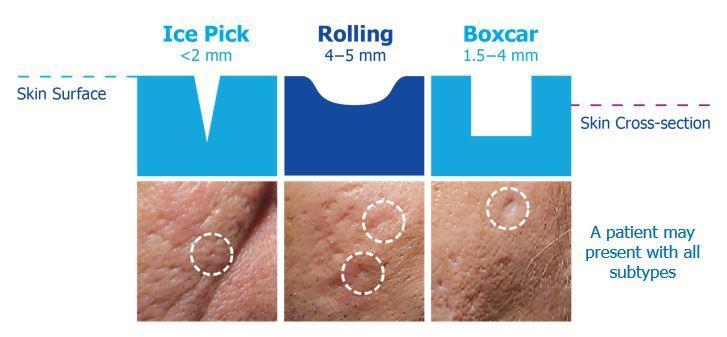 Atrophic Acne Scars Rolling scars improved with