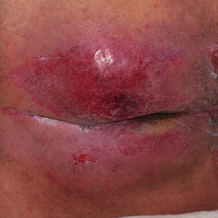 Incontinence-associated dermatitis Moisture-related skin damage occurs when the skin is in contact with excessive fl uid for sustained periods of time.