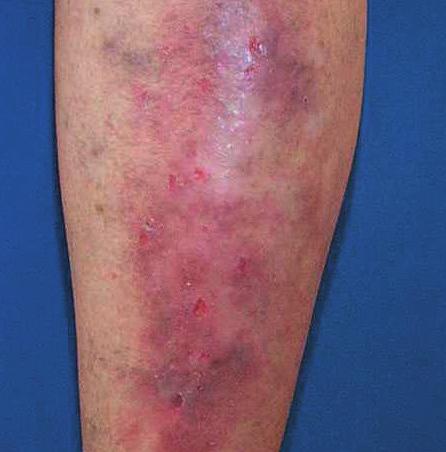 Varicose eczema Varicose eczema is associated with chronic venous insuffi ciency and usually affects the lower legs in the older person.