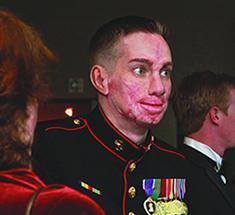 Surgeons Repair the Ravages of War Marine Corps Cpl. Aaron P. Mankin tells the story of his facial reconstruction. Mankin survived a bomb blast in Iraq and has had more than 60 surgeries.