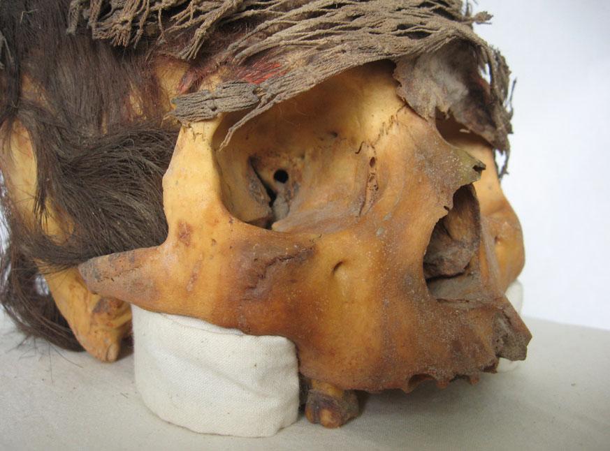 Excess consolidant was removed using a brush and acetone. Consolidation was deemed necessary as fragments of the skull were found to move independently and were at risk of further damage.