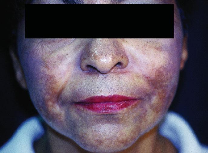 COSMETIC DERMATOLOGY: PRINCIPLES AND PRACTICE 102 MELASMA Melasma, also known as chloasma or the mask of pregnancy, is a very common condition usually seen in women of childbearing age (Fig. 13-5).