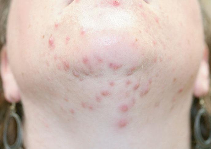 COSMETIC DERMATOLOGY: PRINCIPLES AND PRACTICE The literature reveals no discernible differences in the sebum composition of acne patients as compared to agematched controls.