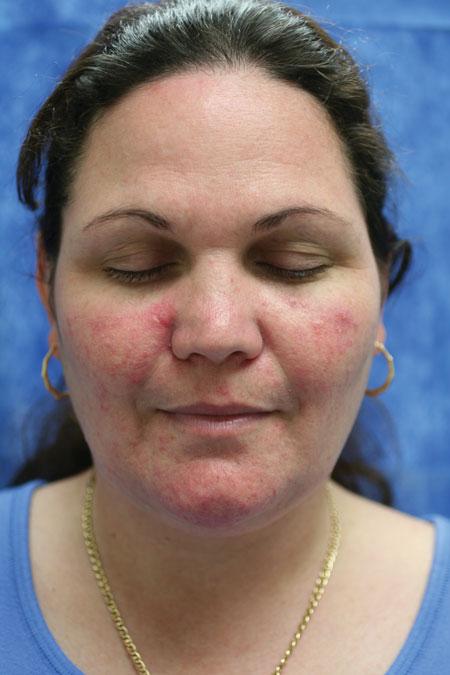 VARIANTS OF ROSACEA The National Rosacea Society Expert Committee has only recognized one variant for rosacea, which is the granulomatous form.