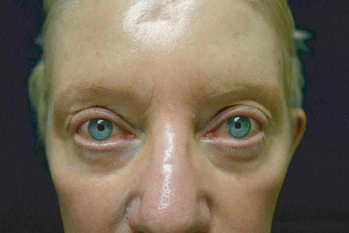 FIGURE 16-4 Ocular rosacea is characterized by bilateral erythema of the conjunctiva and/or eyelids. Chapter 35). Sunscreen and sun avoidance are very important aspects of controlling symptoms.
