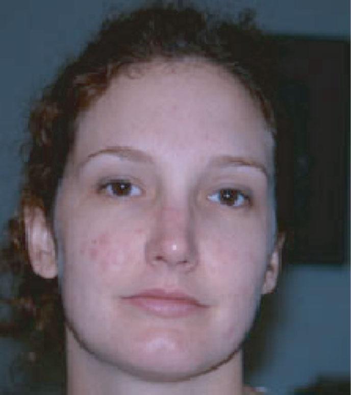 CHAPTER 18 Contact Dermatitis (Type 4 Sensitive Skin) Sharon E.