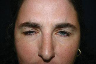 Massaging the toxin into this area usually causes elevation of the medial brow.