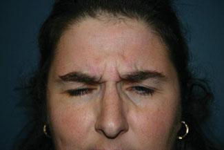 39 In this population the upward pulling of the frontalis muscle is needed to raise the baggy upper eye skin. These patients are better treated with blepharoplasty first, then with BTX.