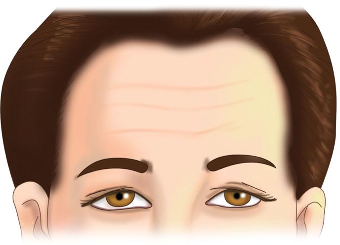 It is crucial to inject the forehead equally on both sides to prevent asymmetry. B supercilii muscle.