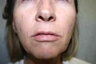 A FIGURE 22-27 A. Patient with a long upper lip. B. Patient with a short upper lip. This patient is a better candidate for Botox injection to raise the tip.