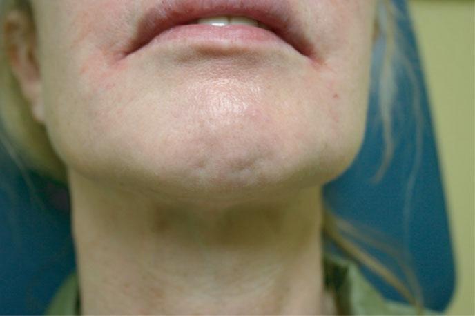 COSMETIC DERMATOLOGY: PRINCIPLES AND PRACTICE 184 FIGURE 22-29 Placement of Botox on the upper lip to treat smoker s lines.