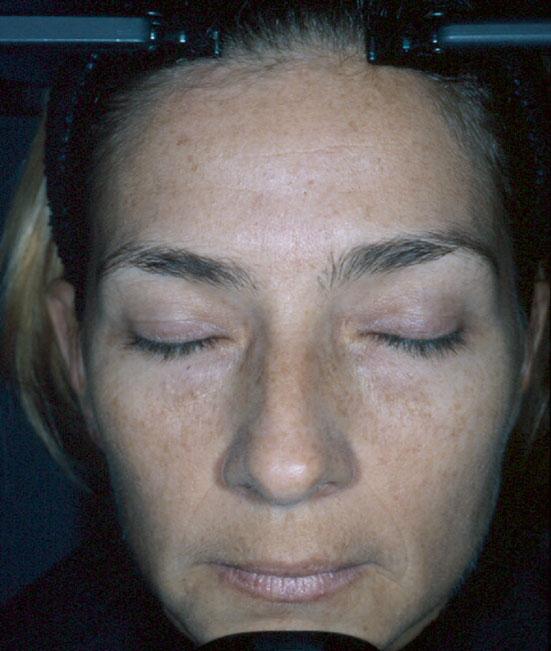 FIGURE 6-2 Facial skin of 25-year-old with normal lens. Sun damage is barely visible.