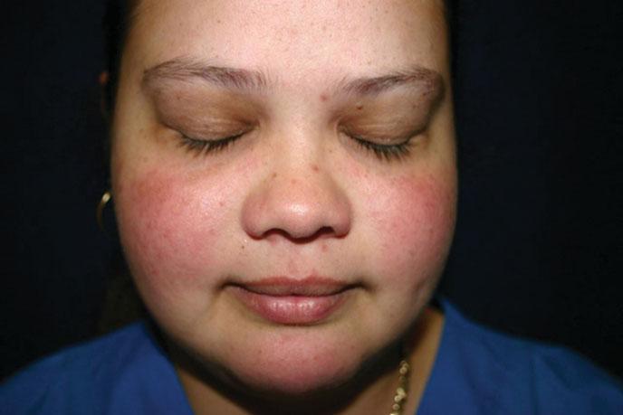 BOX 9-1 Types of Sensitive Skin S1 Acne S2 Rosacea S3 Burning and stinging S4 Susceptibility to contact and irritant dermatitis FIGURE 9-2 This OS 1,2 PT patient has a history of facial flushing,