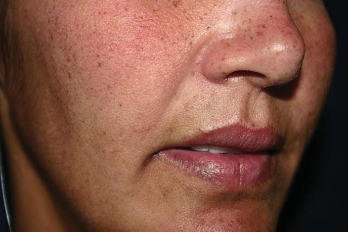 FIGURE 9-6 Pigmented skin types develop solar lentigos, melasma, and postinflammatory hyperpigmentation. Although darker skin types are more likely to be pigmented types, this is not always the case.