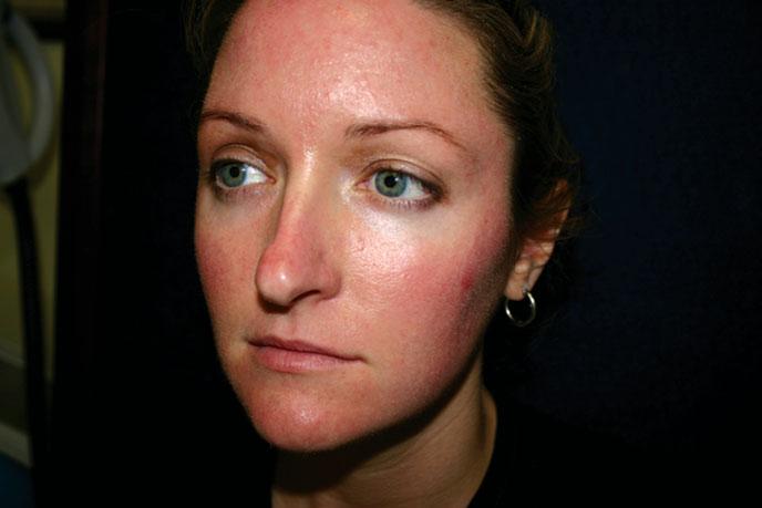 COSMETIC DERMATOLOGY: PRINCIPLES AND PRACTICE FIGURE 9-8 This patient is an OS 2 NW skin type (the S 2 means rosacea type ). She has light eyes and skin and does not tan easily.