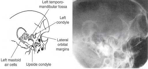 LESSON 6 POSITIONING FOR ADDITIONAL SKULL PROCEDURES Section I. THE TEMPOROMANDIBULAR JOINT AND THE NOSE 6-1.