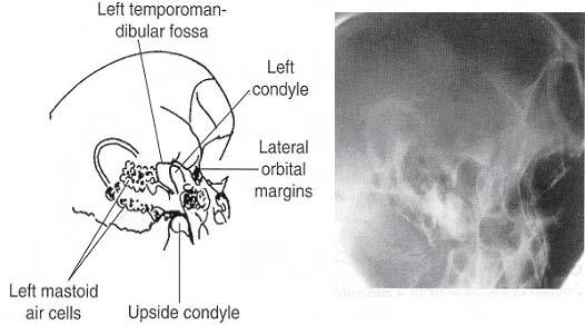 Both views of the temporomandibular joint (TMJ)s are done exactly the same way, except for the letter markers.