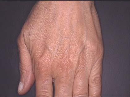 Hands CONCLUSIONS The aim of our test was to evaluate if the product Instant Lifting could induce an immediate lifting effect after its application on the wrinkles of face (periorbital, lip contour)