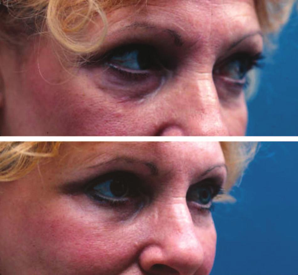 Plastic and Reconstructive Surgery March 2006 Fig. 7. Fat pad elevation and fixation addresses the long lower eyelid, one of the common signs of midface aging. (Above) Preoperative oblique view.