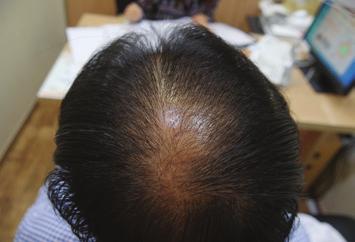 answered positively on effects related to hair loss prevention