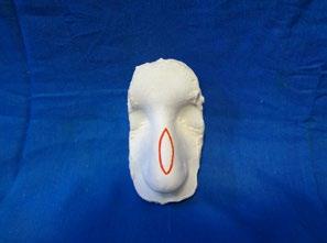 In this work we do not consider patients with great width in the base, but low in the nasal tip noses, as well as noses that had wide nostrils.