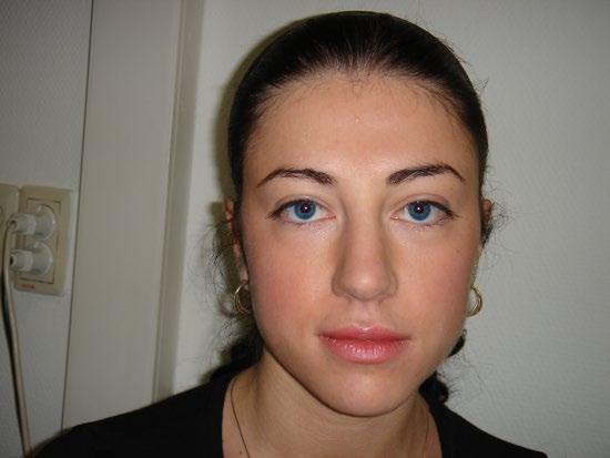 rhinoplasty that required combined excess skin excision in