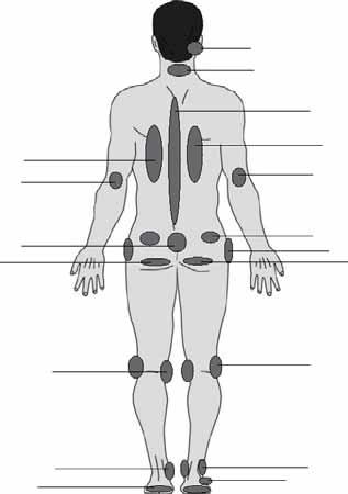 Figure 20.1 shows the areas of the body at highest risk for pressure ulcers. These areas include: Figure 20.1, Pressure Areas 1. Back of the ear. 2. Back of the head. 1 2 3. Shoulder blade. 4.