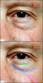 Upper eyelid Ptosis Blepharoplasty Assessment Brow position Degree of excess skin Fat prolapse or atrophy Muscle Lid crease