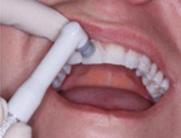 Patient s teeth were cleaned with a soft pumice.