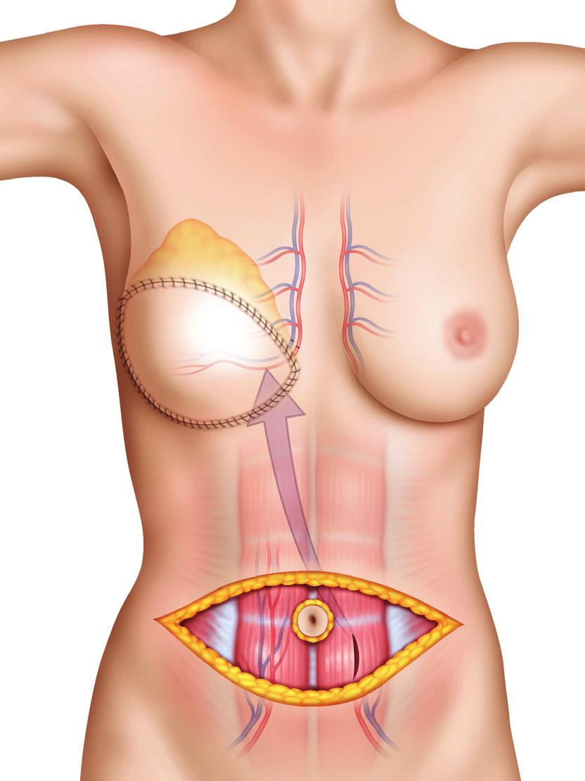 AUTOLOGOUS RECONSTRUCTION OPTIONS ABDOMEN DIEP (DEEP INFERIOR EPIGASTRIC PERFORATOR) SIEA (SUPERFICIAL INFERIOR EPIGASTRIC ARTERY) This procedure uses abdominal tissue but no muscle.