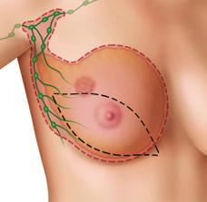 CONSERVING SURGERY A breast conserving surgery (often referred to as a lumpectomy or partial mastectomy) removes only the tumor and a small area of surrounding healthy breast tissue but saves the