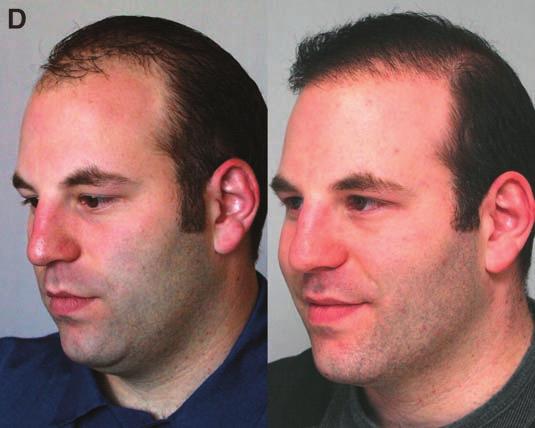 relatively high position of the hairlines 2. minimal to moderate nature of the plug intensity 3. moderately plentiful donor hair supply in the occipital scalp Case 1 Case 1 (Fig.