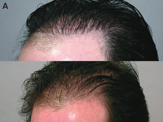 266 J.E. Vogel / Facial Plast Surg Clin N Am 12 (2004) 263 278 area and grafted in the anterior hairline. In two sessions the patient s hairline was acceptable. Case 2 Case 2 (Fig.