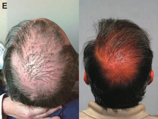 (A) Anterior hairline appearance, preoperative appearance, first session intraoperatively, results