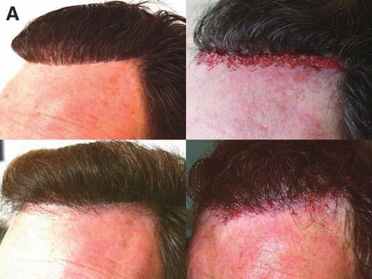 268 J.E. Vogel / Facial Plast Surg Clin N Am 12 (2004) 263 278 scalp. Case 3 underwent three sessions of PR&R to the anterior hairline and crown-vertex area.