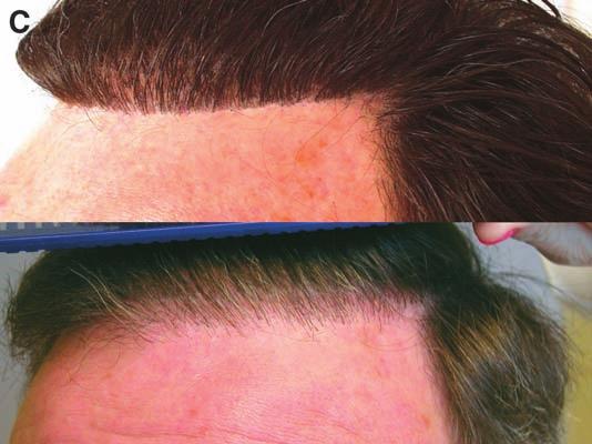 Both patients underwent PR&R and approximately 1500 grafts at the anterior hairline and crown-vertex area.