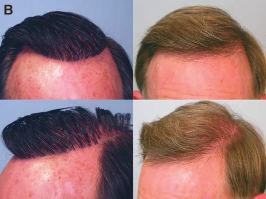 (B, C) Results following fourth session of PR&R plus approximately 1500 grafts to anterior hairline and crown-vertex area.