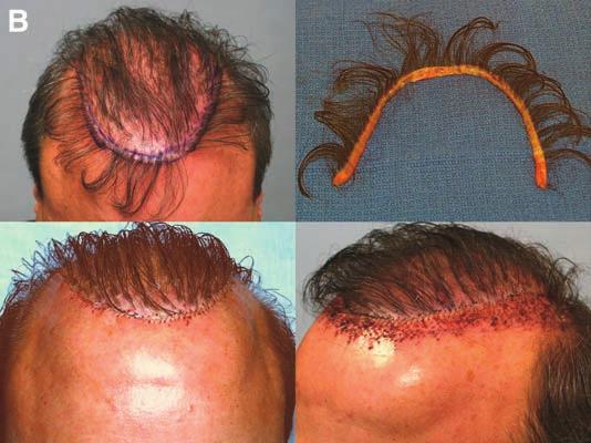 (A) Anterior hairline and crown-vertex appearance, preoperative appearance.