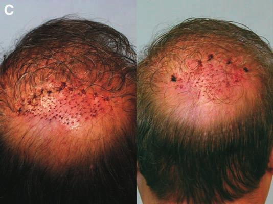 closure of the hairline excision wound, and recycled hair grafts placed in an irregular
