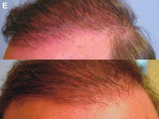 Results are seen about 1 year following the last procedure. natural and undetectable.
