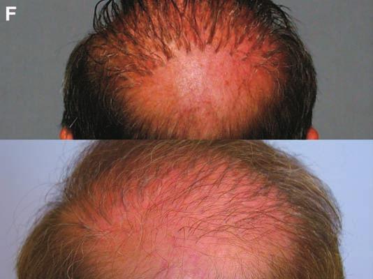 A mature man s hairline is usually not less than 8.0 to 8.5 cm from the midglabela area.