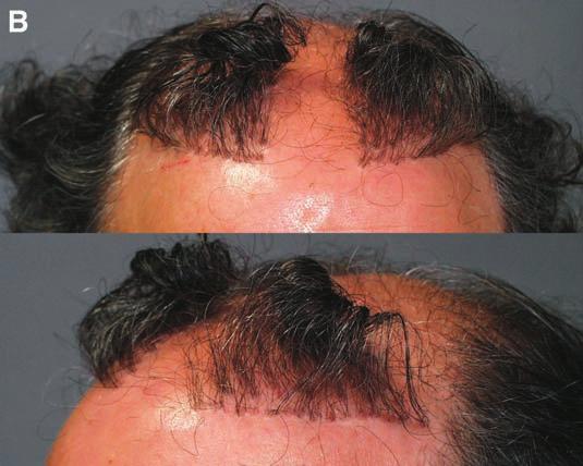 (A, B) Preoperative appearance of low positioned, pluggy grafts that became isolated