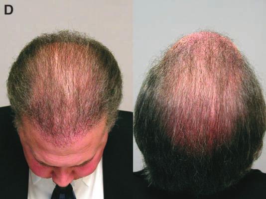 (D, E) Result following third session of grafting alone plus 3000 grafts.