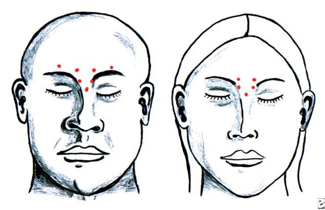 Treatment strategy Area glabella forehead upper lat.